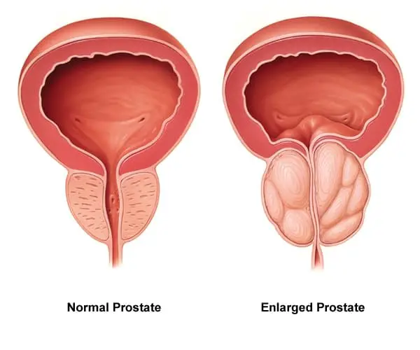 gingembre et prostate stretching pentru prostatită