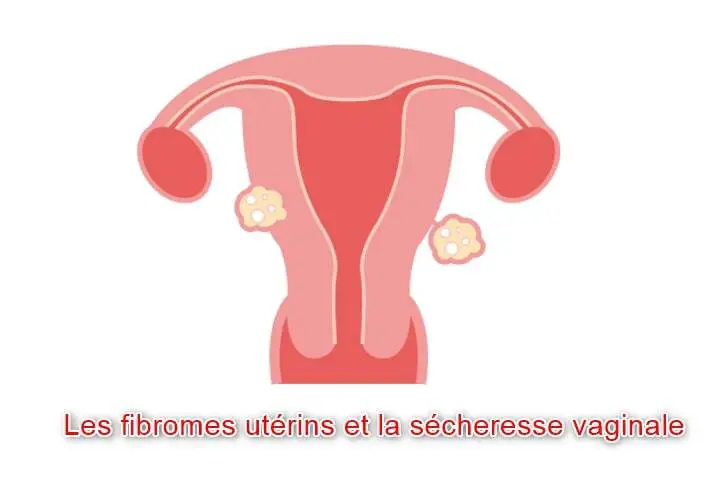 L’aloe vera pour les fibromes utérins et la sécheresse vaginale 1