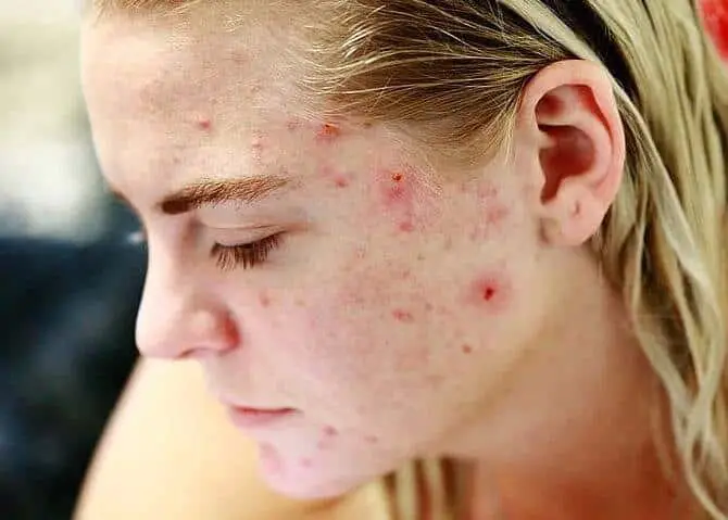 berbérine pour atténuer les effets de l’acné et des cicatrices