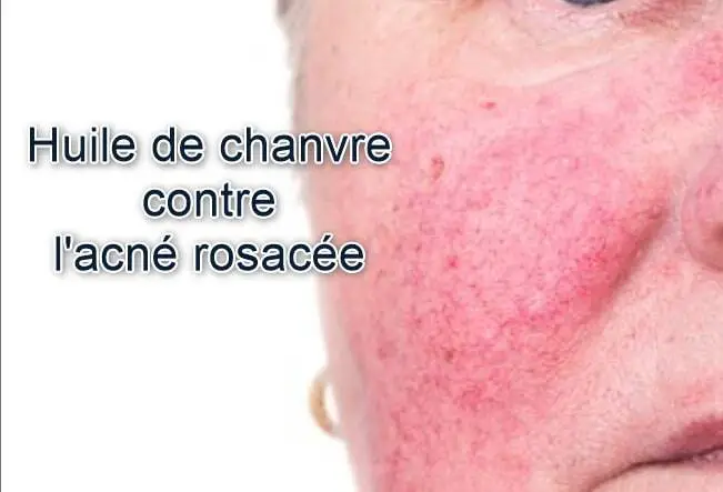 Utilisation de l'huile de chanvre contre l'acné rosacée 2