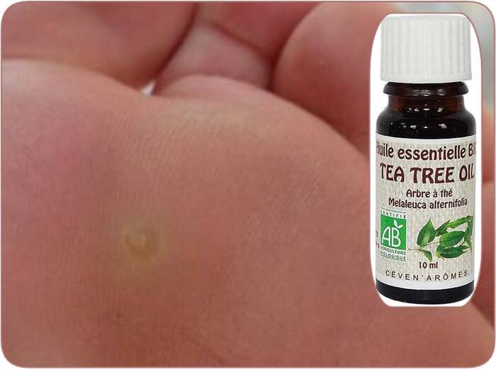 huile essentielle tea tree pour soigner les cors au pied